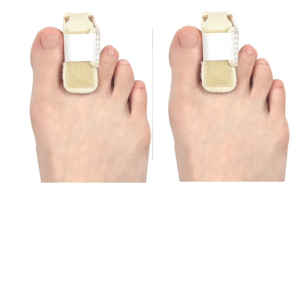 ALIGVIA - Adjustable Toe Splint for Cushioned Alignment Support